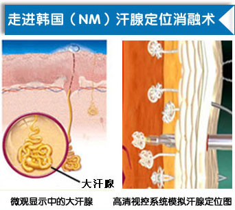 腋臭的危害有哪些 改良小切口汗腺清除术.jpg