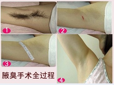 伤口追踪
