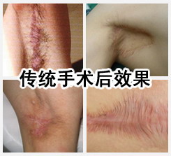 传统手术术后效果.JPG