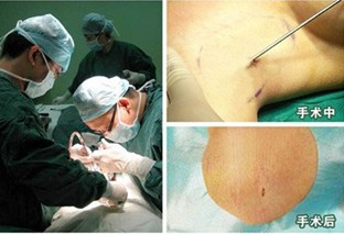 改良小切口汗腺清除术手术过程及效果展现 手术过程.JPG